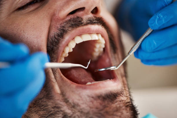 Best Emergency Tooth Extraction in Union, OH